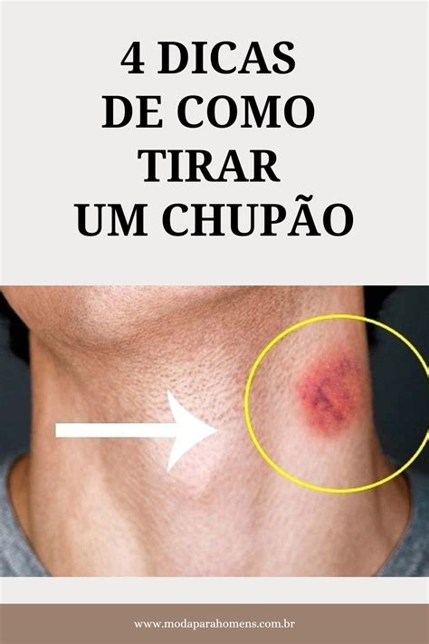 como tirar chupada|Como tirar chupão: 11 dicas fáceis para disfarçar a。